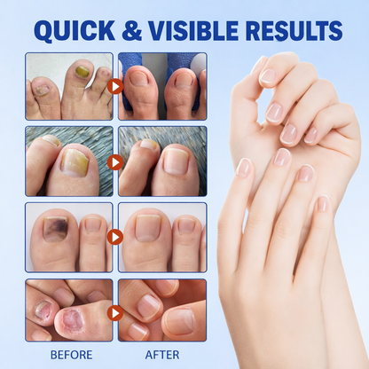 Nail Treatment Fungal Nail Patches (Pack of 1 )